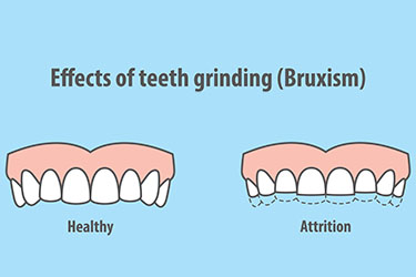 Teeth Grinding Damage Pro Teeth Guard