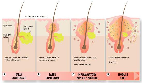 clogged pores and acne treatment