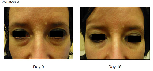 Eyeseryl Before and After Volunteer A