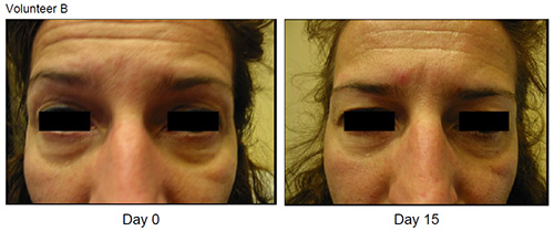 Eyeseryl Before and After Volunteer B