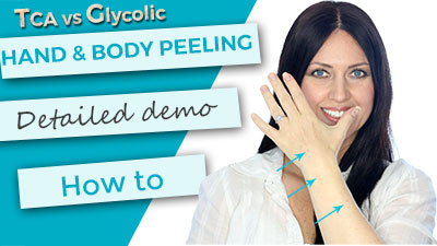 Hand and Body Peeling TCA 30 versus Glycolic 70 Demonstration
