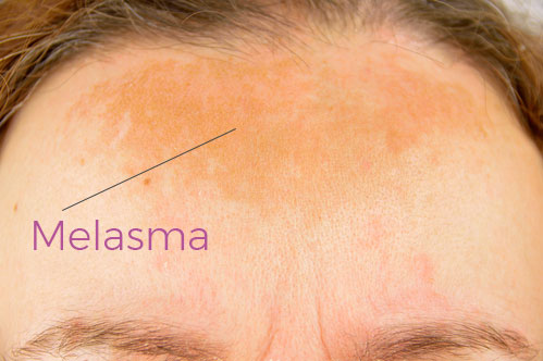 Melasma is commonly found on the forehead area. It can be treated by melanin inhibitors and chemical peels, but is still a chronic issue. 