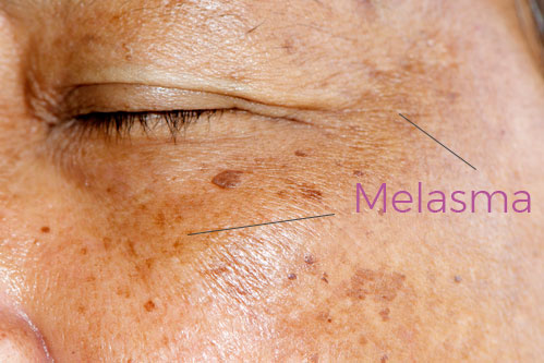 Melasma is a chronic condition that will need to be continuously treated. 