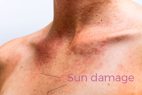Sun damage stems from too much localized pigmentation in the skin. Sun burns and excessive UV exposure cause pigmentation. 