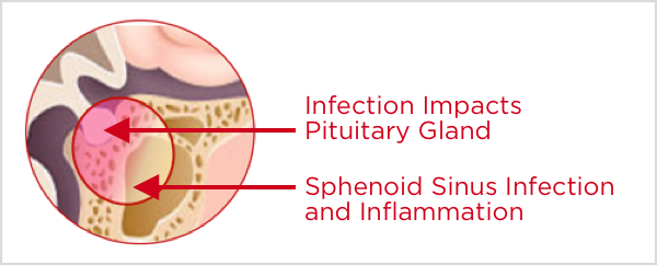 Pituitary Gland Impacted by Infection in Sphenoid Sinus