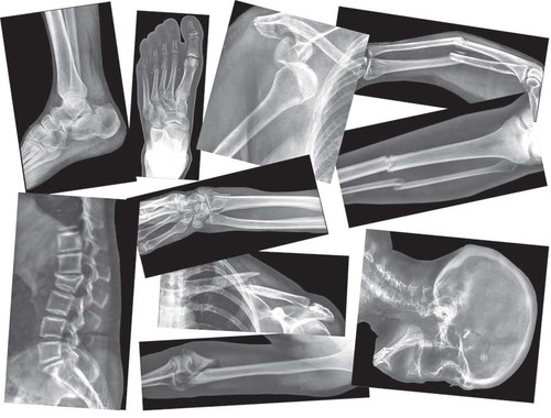 Broken Bones X-Ray Set